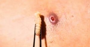 Gusano-Barrenador-Humanos-Emergencia-Secretaria-de-Salud