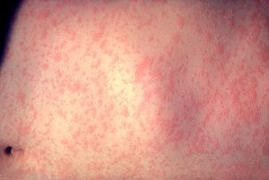 Morbillivirus_measles_infection